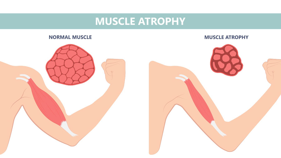 《经济学人》每日一词：atrophy